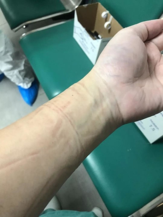 脱下防护服后,手腕上留下了道道勒痕.